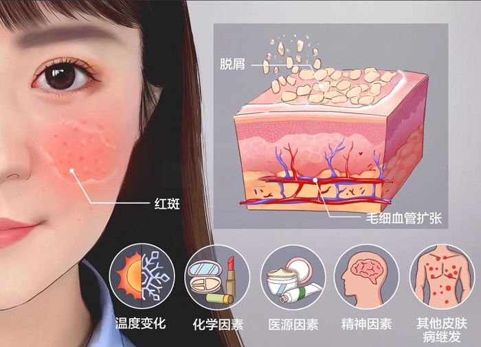 敏感肌脸不舒服还要护肤吗？脸泛红刺痛这样护理