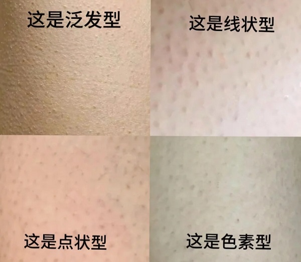 鸡皮肤会伴随一生吗？鸡皮肤有没有什么方法消除